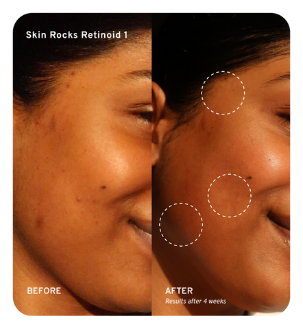 A before and after shot after using the Skin Rocks Retinoid 2